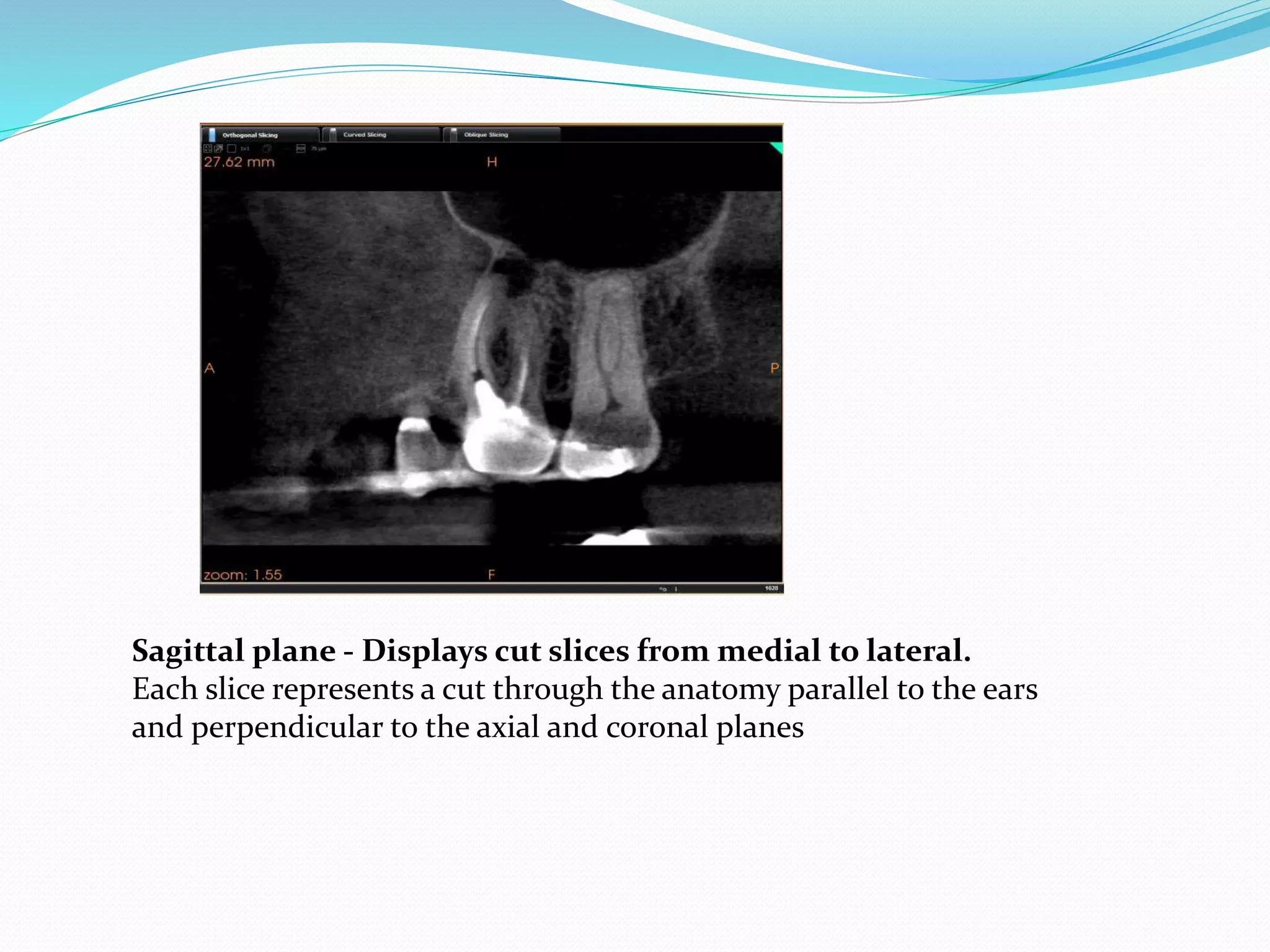 Sagittal plane - Displays cut slices from medial to lateral.
Each slice represents a cut through the anatomy parallel to the ears
and perpendicular to the axial and coronal planes
 