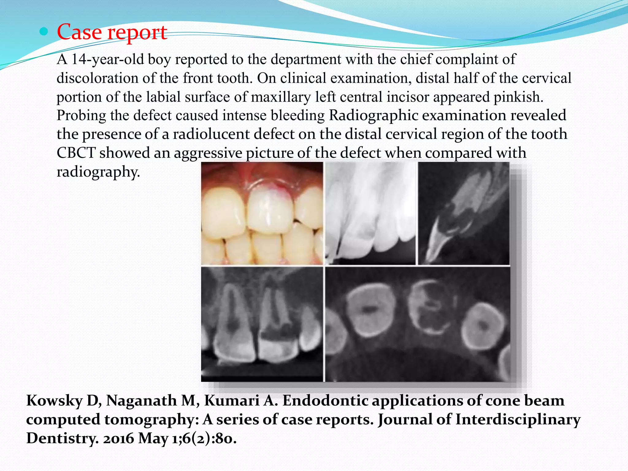  Case report
A 14-year-old boy reported to the department with the chief complaint of
discoloration of the front tooth. On clinical examination, distal half of the cervical
portion of the labial surface of maxillary left central incisor appeared pinkish.
Probing the defect caused intense bleeding Radiographic examination revealed
the presence of a radiolucent defect on the distal cervical region of the tooth
CBCT showed an aggressive picture of the defect when compared with
radiography.
Kowsky D, Naganath M, Kumari A. Endodontic applications of cone beam
computed tomography: A series of case reports. Journal of Interdisciplinary
Dentistry. 2016 May 1;6(2):80.
 
