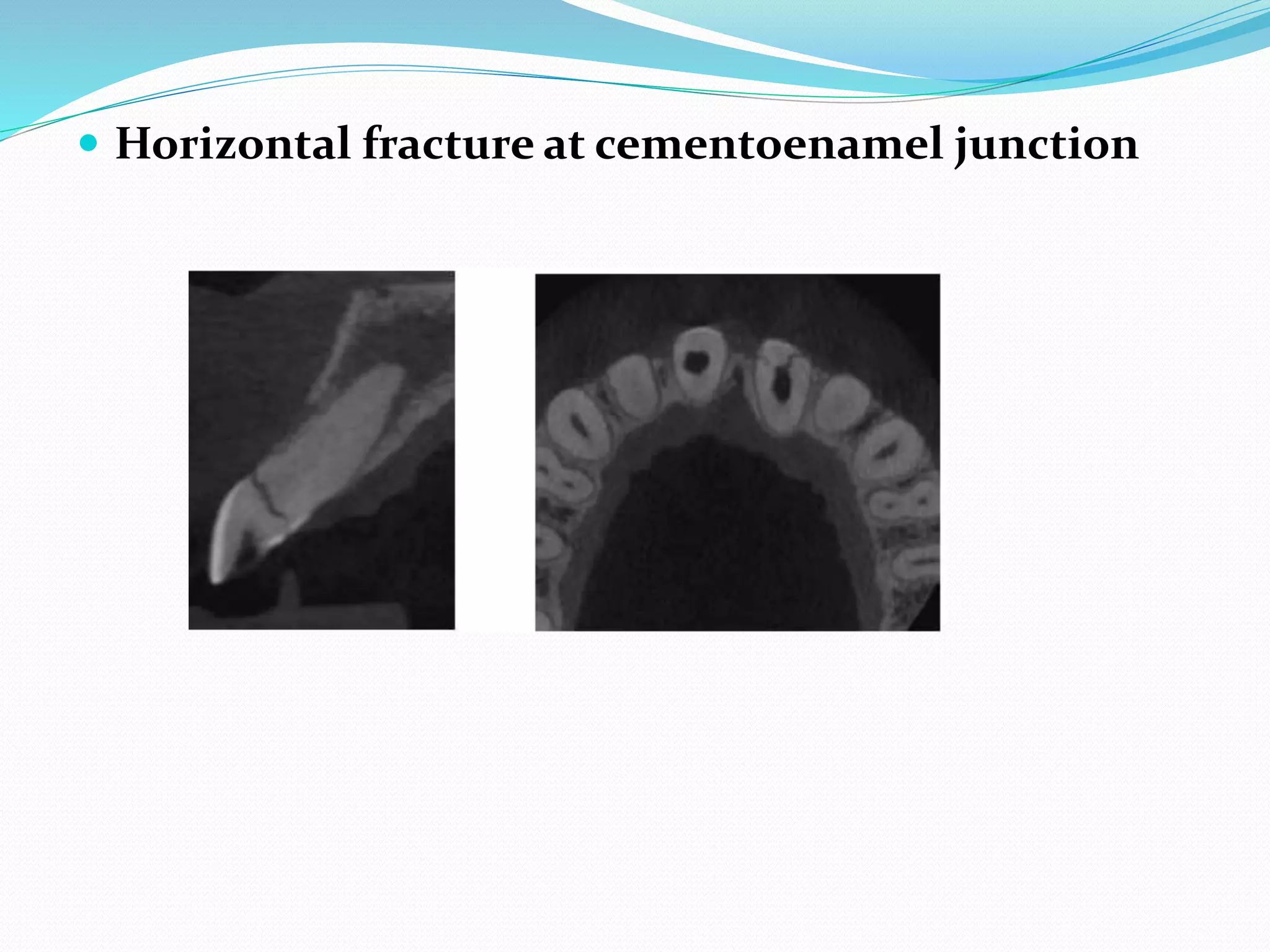  Horizontal fracture at cementoenamel junction
 