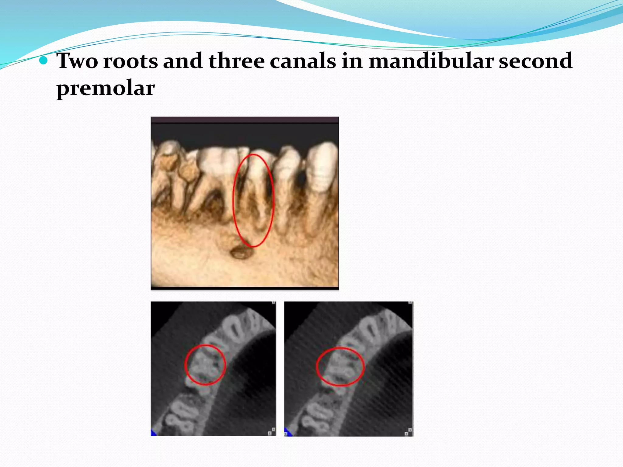  Two roots and three canals in mandibular second
premolar
 