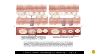 Carranza’s clinical Perioontology, 13th edition ;pg 747; fig 75.9 57
 