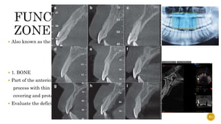  Also known as the “traumatic zone”
 1. BONE
 Part of the anterior maxilla is a protruding alveolar
process with thin labial and thick palatal cortical plates
covering and protecting upper front teeth.
 Evaluate the deficiency
61
 