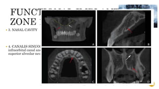  3. NASAL CAVITY
 4. CANALIS SINUOSUS - is a bone canal in the maxilla that branches from the
infraorbital canal and ends laterally to the anterior nasal spine and contains the anterior
superior alveolar neurovascular bundles
63
 