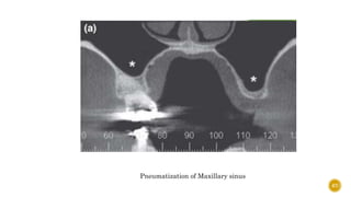 67
Pneumatization of Maxillary sinus
 