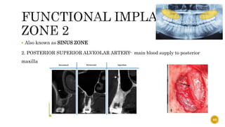  Also known as SINUS ZONE
2. POSTERIOR SUPERIOR ALVEOLAR ARTERY- main blood supply to posterior
maxilla
68
 