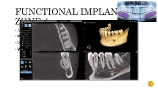  Also knows as ISCHEMIC ZONE.
 MANDIBULAR CANAL
 Importance- carries inferior alveolar neurovascular bundle
 Variations-
74
 
