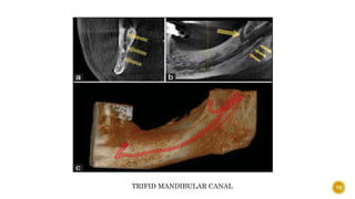 76
TRIFID MANDIBULAR CANAL
 