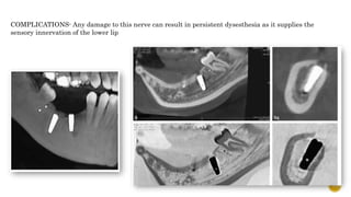 77
COMPLICATIONS- Any damage to this nerve can result in persistent dysesthesia as it supplies the
sensory innervation of the lower lip
 
