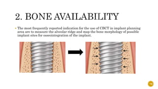  The most frequently reported indication for the use of CBCT in implant planning
area are to measure the alveolar ridge and map the bone morphology of possible
implant sites for osseointegration of the implant.
78
 