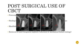  Postsurgical complications (e.g. neurovascular trauma)
 Healing follow-up of complex surgical procedures and crestal bone changes
 Maxillofacial trauma with suspected complications at the implant level
 Retrieval of osseo-integrated implants (infectious or mechanical failure etiology)
84
 