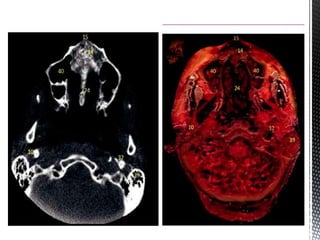 CBCT_INTERPRETATION CBCT APPLICATIONS & READING.pptx