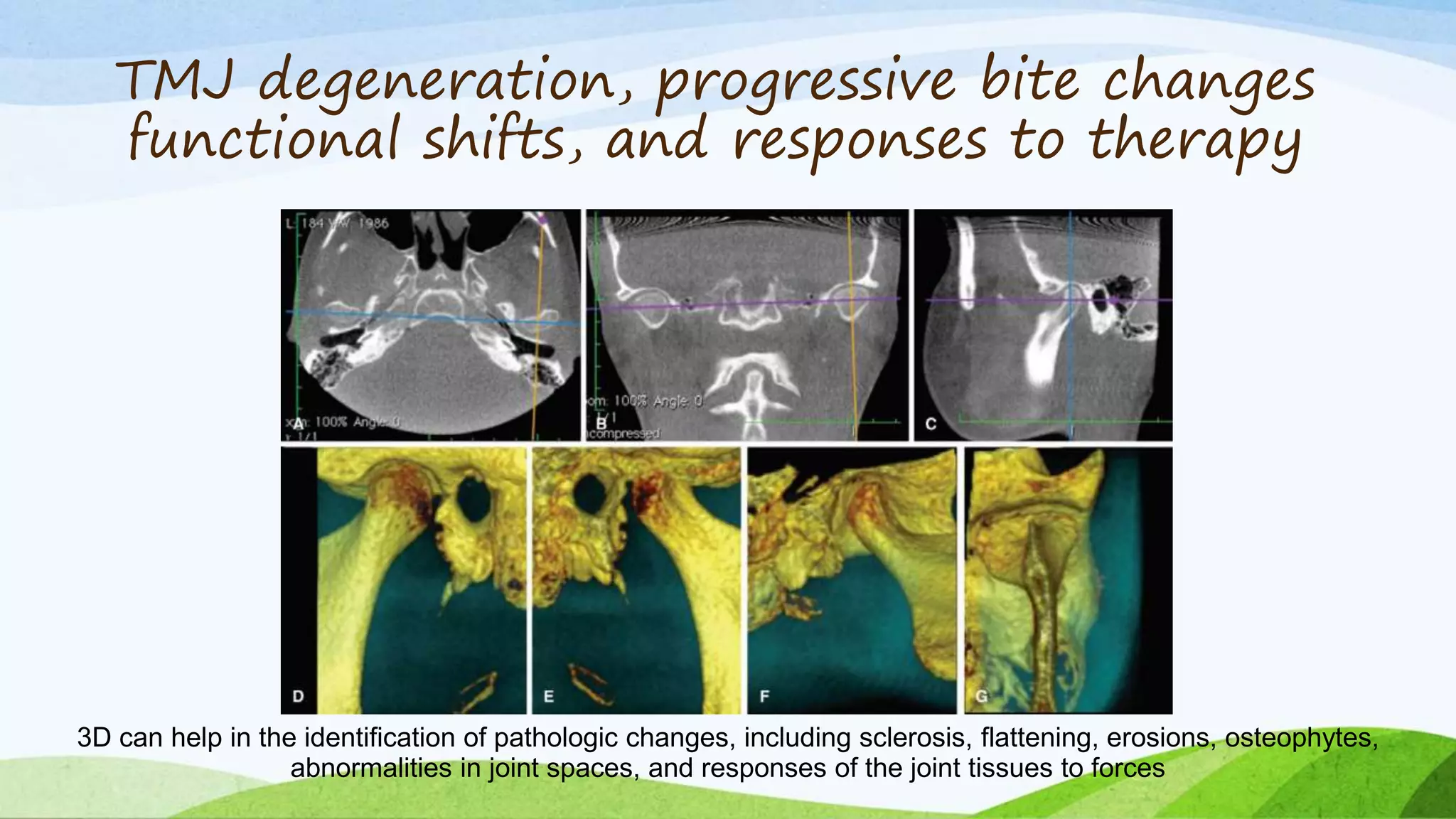 TMJ degeneration, progressive bite changes
functional shifts, and responses to therapy
3D can help in the identification of pathologic changes, including sclerosis, flattening, erosions, osteophytes,
abnormalities in joint spaces, and responses of the joint tissues to forces
 