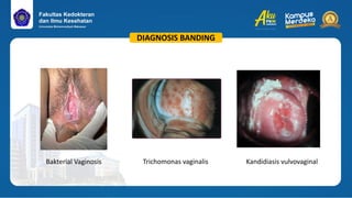 CBD_Bakterial Vaginosis_Rahmadani Mutiara Bahtiar.pdf