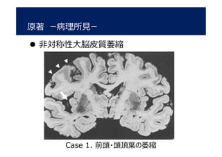 原著 ー病理所見ー
 非対称性大脳皮質萎縮
Case 1. 前頭・頭頂葉の萎縮
 
