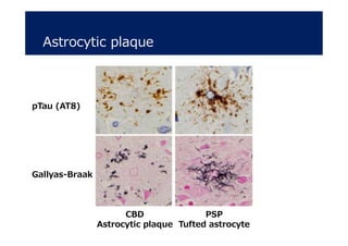 Astrocytic plaque
PSP
Tufted astrocyte
pTau (AT8)
Gallyas-Braak
CBD
Astrocytic plaque
 