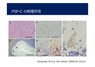 F
PSP-C の病理所見
Kanazawa M et al. Mov Disord. 2009;24:1312-8.
 