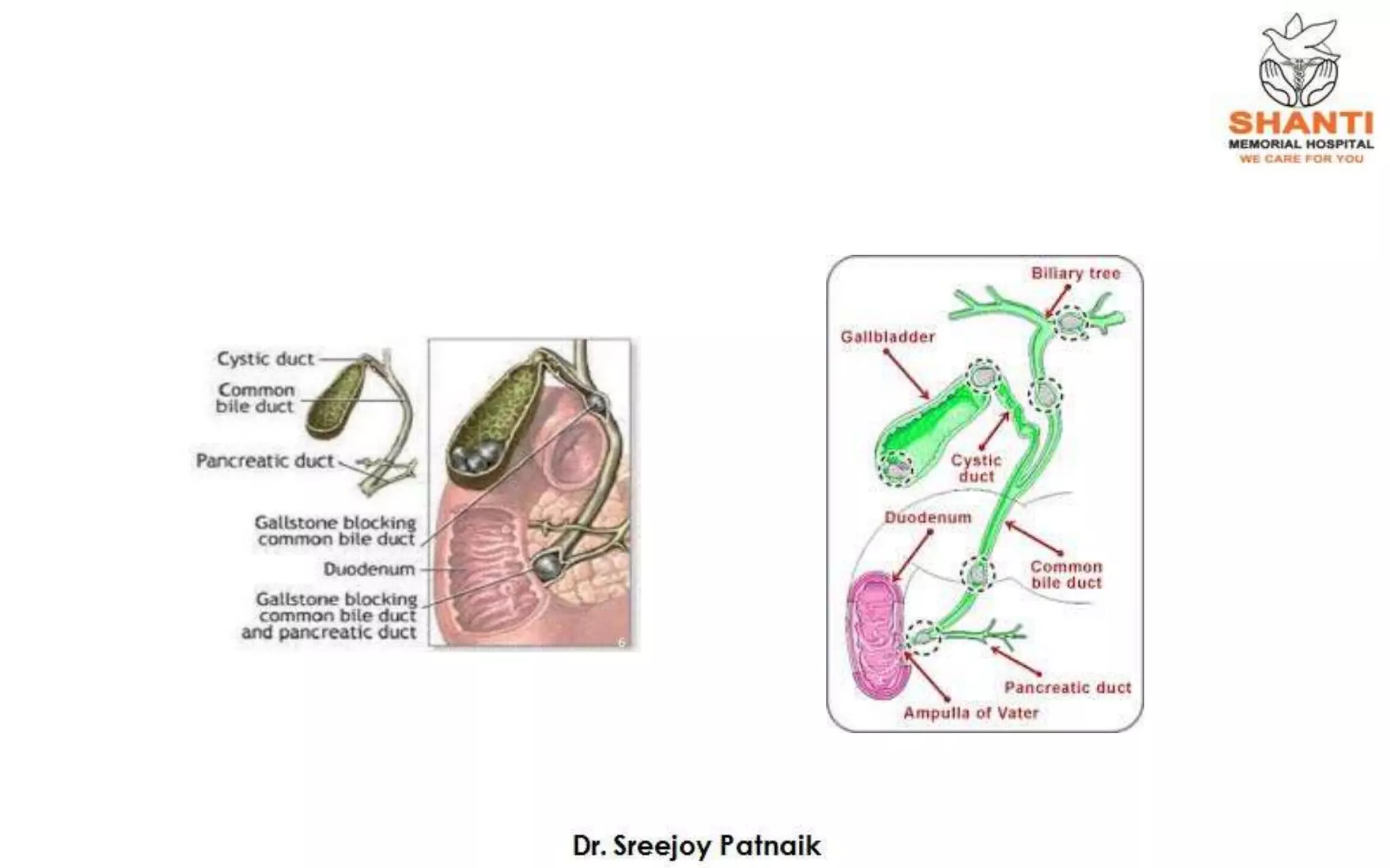 CBD Stones Technical Challenges | PPTX | Digestive Disorders | Diseases ...