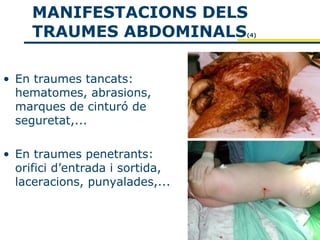 MANIFESTACIONS DELS
     TRAUMES ABDOMINALS          (4)




• En traumes tancats:
  hematomes, abrasions,
  marques de cinturó de
  seguretat,...

• En traumes penetrants:
  orifici d’entrada i sortida,
  laceracions, punyalades,...
 