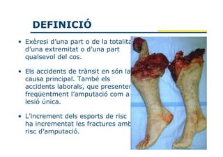 DEFINICIÓ
• Exèresi d’una part o de la totalitat
  d’una extremitat o d’una part
  qualsevol del cos.

• Els accidents de trànsit en són la
  causa principal. També els
  accidents laborals, que presenten
  freqüentment l’amputació com a
  lesió única.

• L’increment dels esports de risc
  ha incrementat les fractures amb
  risc d’amputació.
 