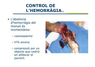 CONTROL DE
            L’HEMORRÀGIA   (1)




• L’absència
  d’hemorràgia del
  monyó és
  momentània:

  – vasoespasme

  – hTA severa

  – compressió per un
    objecte que cedirà
    en alliberar el
    pacient.
 