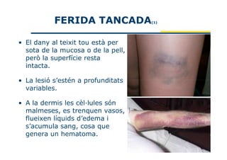 FERIDA TANCADA           (1)




• El dany al teixit tou està per
  sota de la mucosa o de la pell,
  però la superfície resta
  intacta.

• La lesió s’estén a profunditats
  variables.

• A la dermis les cèl·lules són
  malmeses, es trenquen vasos,
  flueixen líquids d’edema i
  s’acumula sang, cosa que
  genera un hematoma.
 