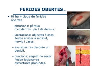 FERIDES OBERTES              (2)



• Hi ha 4 tipus de ferides
  obertes :
  – abrasions: pèrdua
    d’epidermis i part de dermis.

  – laceracions: objectes filosos.
    Poden arribar a múscul,
    nervis i vasos.

  – avulsions: es desprèn un
    penjoll.

  – puncions: sagnat no sever.
    Poden lesionar·se
    estructures profundes.
 