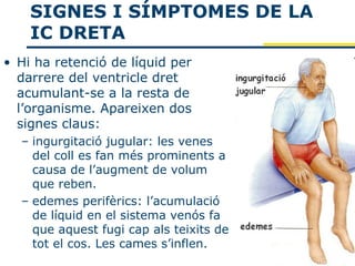 SIGNES I SÍMPTOMES DE LA
    IC DRETA
• Hi ha retenció de líquid per
  darrere del ventricle dret
  acumulant-se a la resta de
  l’organisme. Apareixen dos
  signes claus:
  – ingurgitació jugular: les venes
    del coll es fan més prominents a
    causa de l’augment de volum
    que reben.
  – edemes perifèrics: l’acumulació
    de líquid en el sistema venós fa
    que aquest fugi cap als teixits de
    tot el cos. Les cames s’inflen.
 