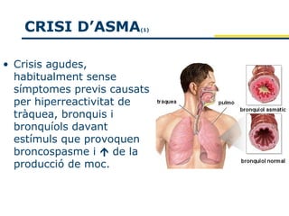 CRISI D’ASMA         (1)




• Crisis agudes,
  habitualment sense
  símptomes previs causats
  per hiperreactivitat de
  tràquea, bronquis i
  bronquíols davant
  estímuls que provoquen
  broncospasme i  de la
  producció de moc.
 