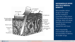 MICRONEEDLES OFFER
MULTIPLE MEDICAL
BENEFITS
Microneedles deliver
drugs to the upper
dermis instead of
muscular or fatty t...