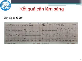 Kết quả cận lâm sàng
11
Điện tâm đồ 12 CĐ
 