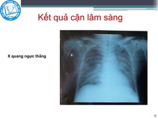 Kết quả cận lâm sàng
12
X quang ngực thẳng
 