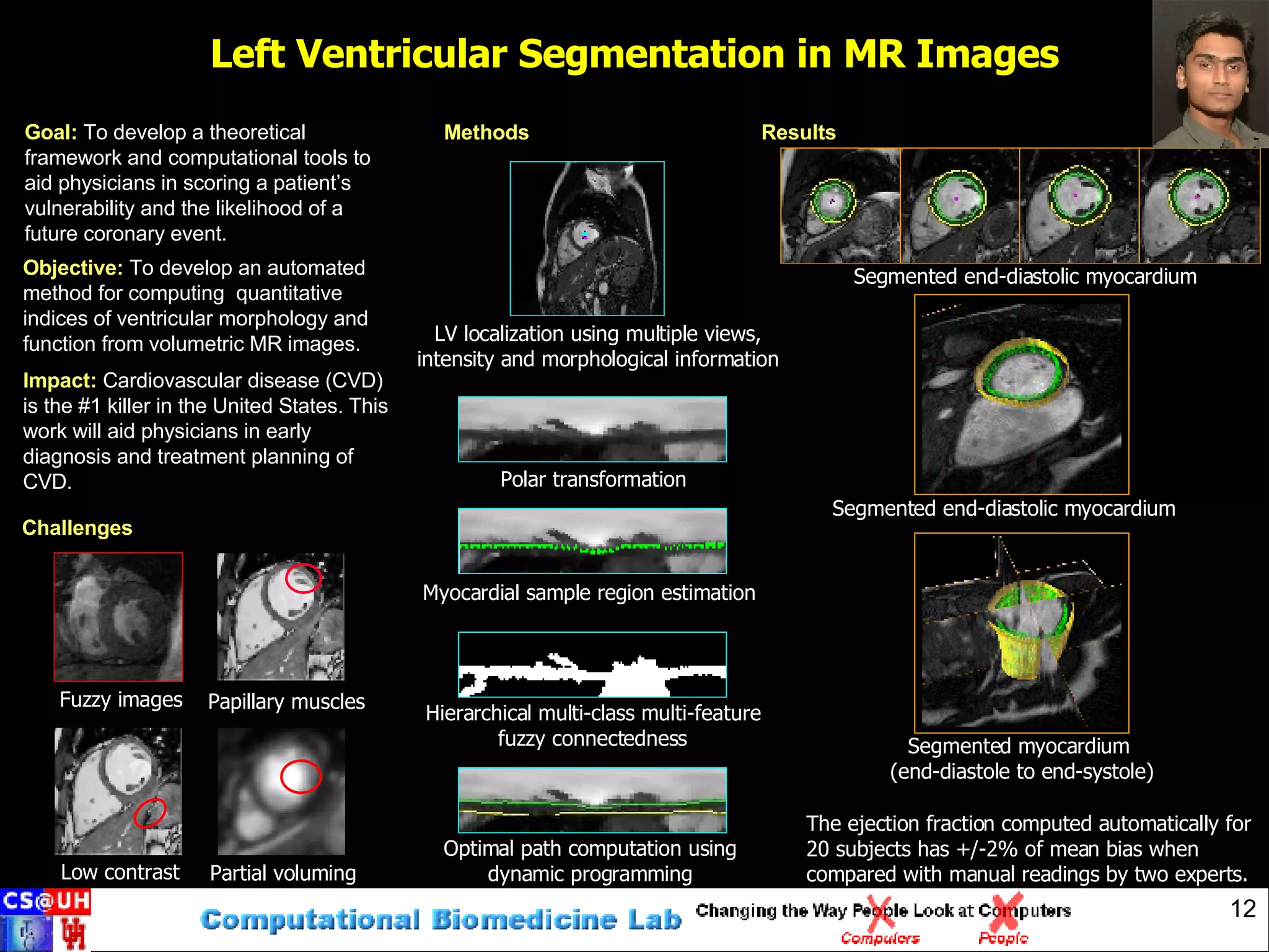 Left Ventricular Segmentation in MR Images Objective:  To develop an automated method for computing  quantitative indices of ventricular morphology and function from volumetric MR images. Papillary muscles Partial voluming Fuzzy images Low contrast Challenges Methods LV localization using multiple views, intensity and morphological information Myocardial sample region estimation Hierarchical multi-class multi-feature fuzzy connectedness Optimal path computation using dynamic programming Polar transformation Results Goal:  To develop a theoretical framework and computational tools to aid physicians in scoring a patient’s vulnerability and the likelihood of a future coronary event. Segmented end-diastolic myocardium The ejection fraction computed automatically for 20 subjects has +/-2% of mean bias when compared with manual readings by two experts. Segmented myocardium  (end-diastole to end-systole) Segmented end-diastolic myocardium Impact:  Cardiovascular disease (CVD) is the #1 killer in the United States. This work will aid physicians in early diagnosis and treatment planning of CVD. 