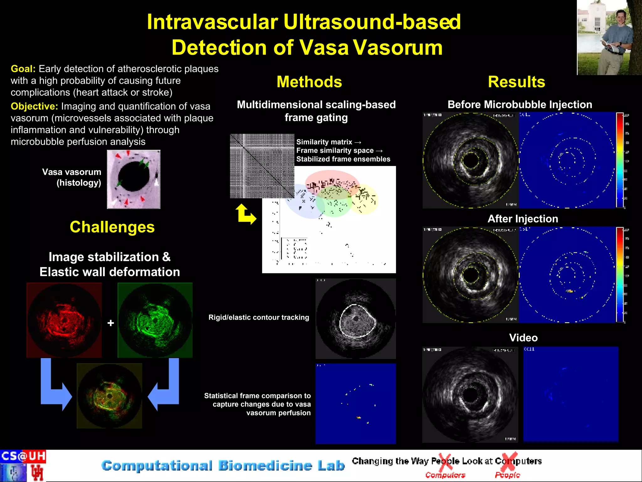 Intravascular Ultrasound-based  Detection of Vasa Vasorum Challenges Results Methods Inter-frame motion Image stabilization & Elastic wall deformation Vasa vasorum (histology) After Injection Goal:   Early detection of atherosclerotic plaques with a high probability of causing future complications (heart attack or stroke) Objective:   Imaging and quantification of vasa vasorum (microvessels associated with plaque inflammation and vulnerability) through microbubble perfusion analysis Video Multidimensional scaling-based frame gating Rigid/elastic contour tracking Statistical frame comparison to capture changes due to vasa vasorum perfusion Before Microbubble Injection + Similarity matrix  -> Frame similarity space  ->   Stabilized frame ensembles 