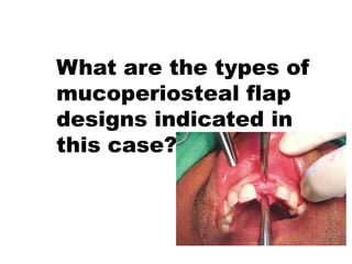 What are the types of
mucoperiosteal flap
designs indicated in
this case?
 