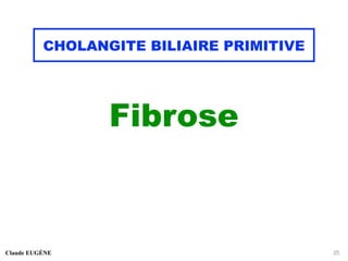 CHOLANGITE BILIAIRE PRIMITIVE
Fibrose
Claude EUGÈNE 25
 