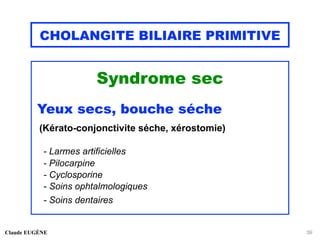 CHOLANGITE BILIAIRE PRIMITIVE
Syndrome sec
Yeux secs, bouche séche
(Kérato-conjonctivite séche, xérostomie)
- Larmes artificielles
- Pilocarpine
- Cyclosporine
- Soins ophtalmologiques
- Soins dentaires
Claude EUGÈNE 39
 