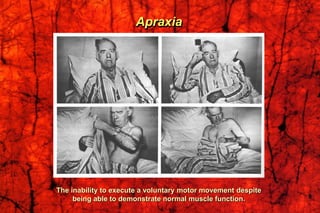 Apraxia
The inability to execute a voluntary motor movement despite
being able to demonstrate normal muscle function.
 
