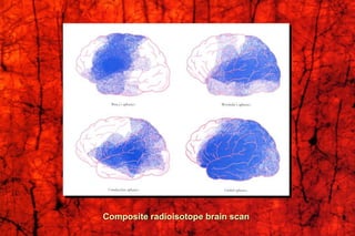Composite radioisotope brain scan
 