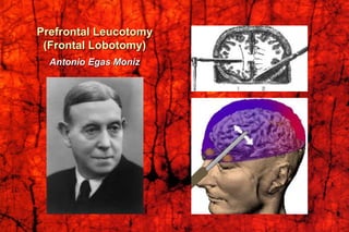 Prefrontal Leucotomy
(Frontal Lobotomy)
Antonio Egas Moniz
 