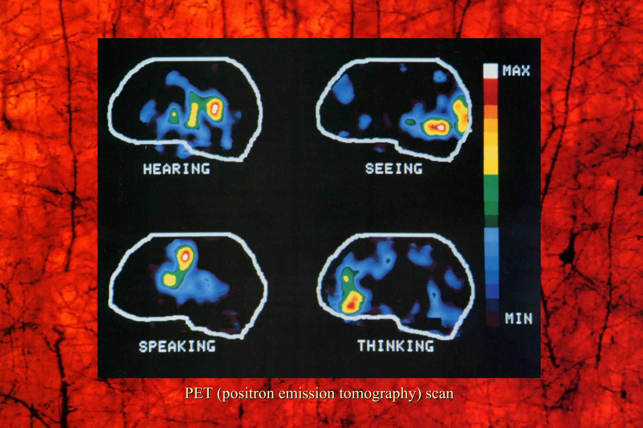 PET (positron emission tomography) scan 