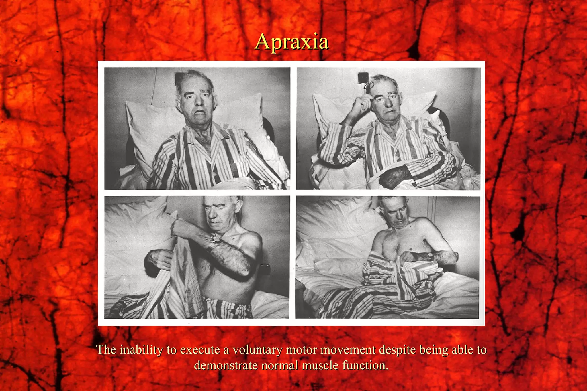 Apraxia The inability to execute a voluntary motor movement despite being able to demonstrate normal muscle function. 