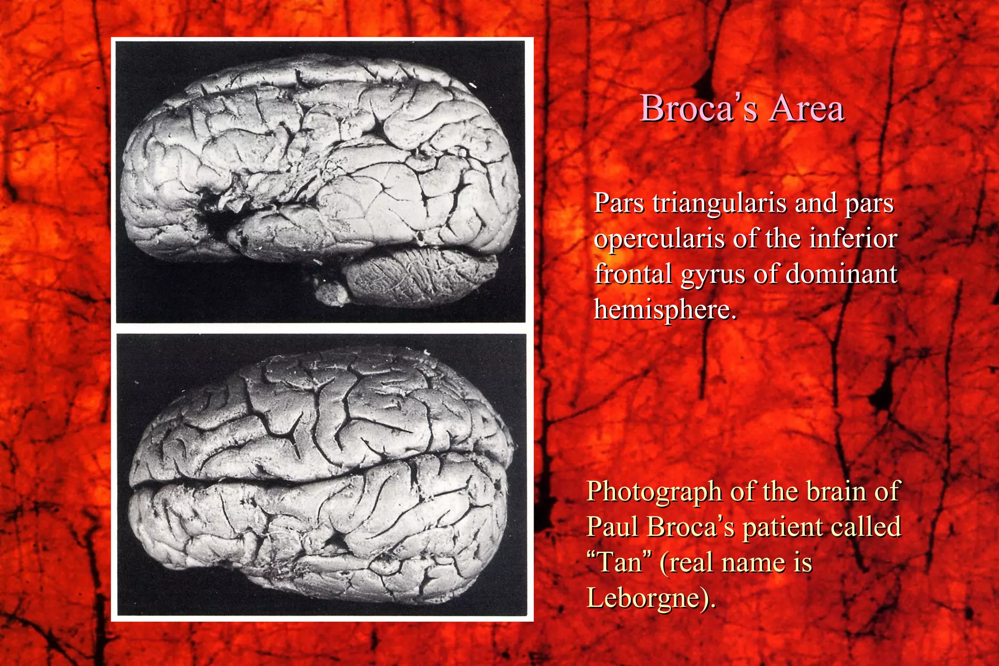 Photograph of the brain of Paul Broca ’ s patient called  “ Tan ”  (real name is Leborgne). Broca ’ s Area Pars triangularis and pars opercularis of the inferior frontal gyrus of dominant hemisphere. 
