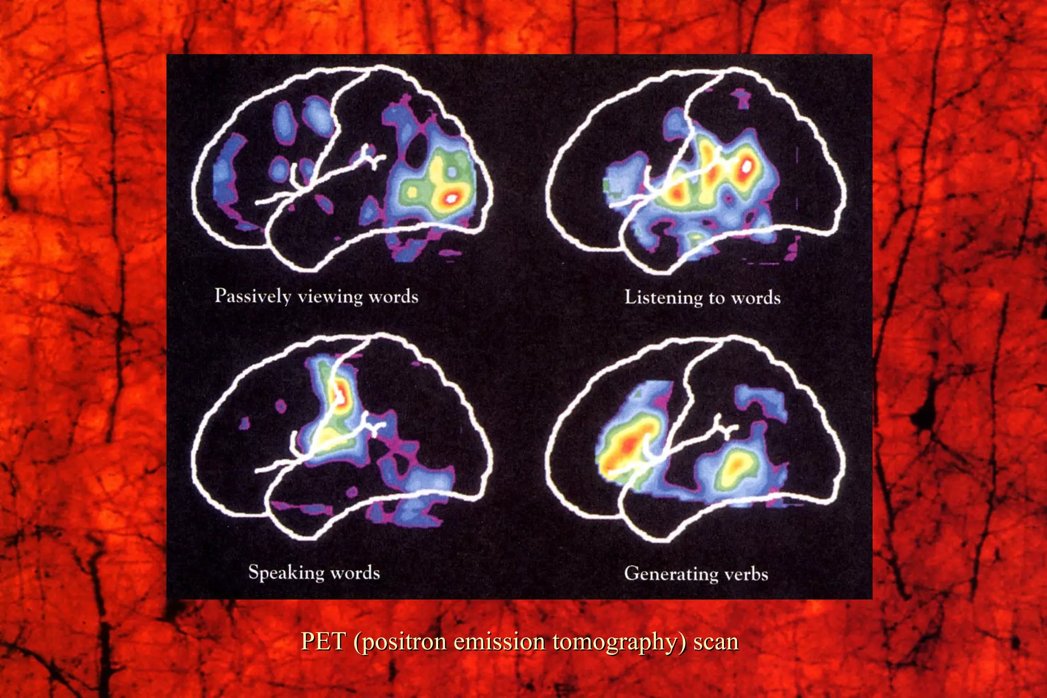 PET (positron emission tomography) scan 