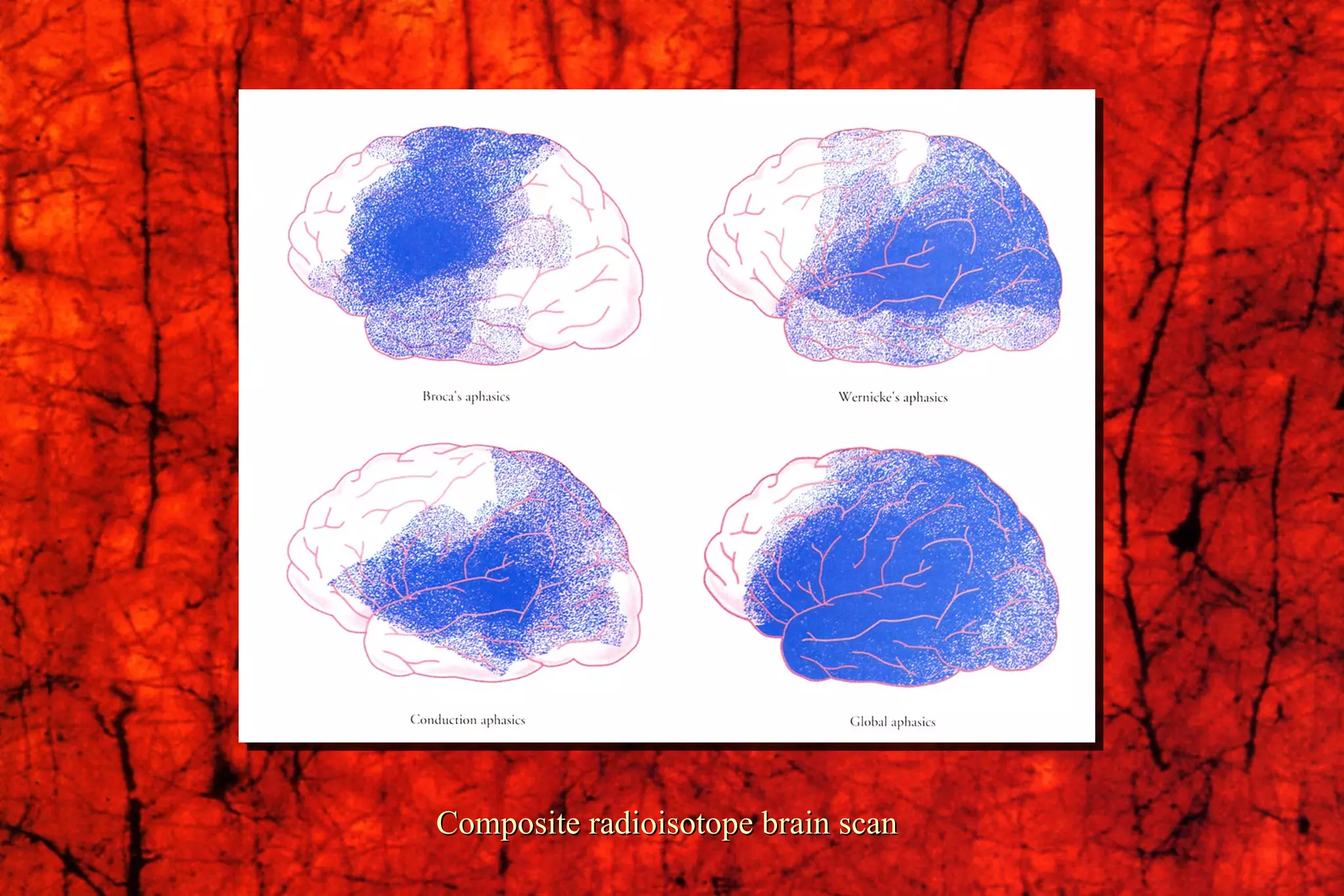 Composite radioisotope brain scan 