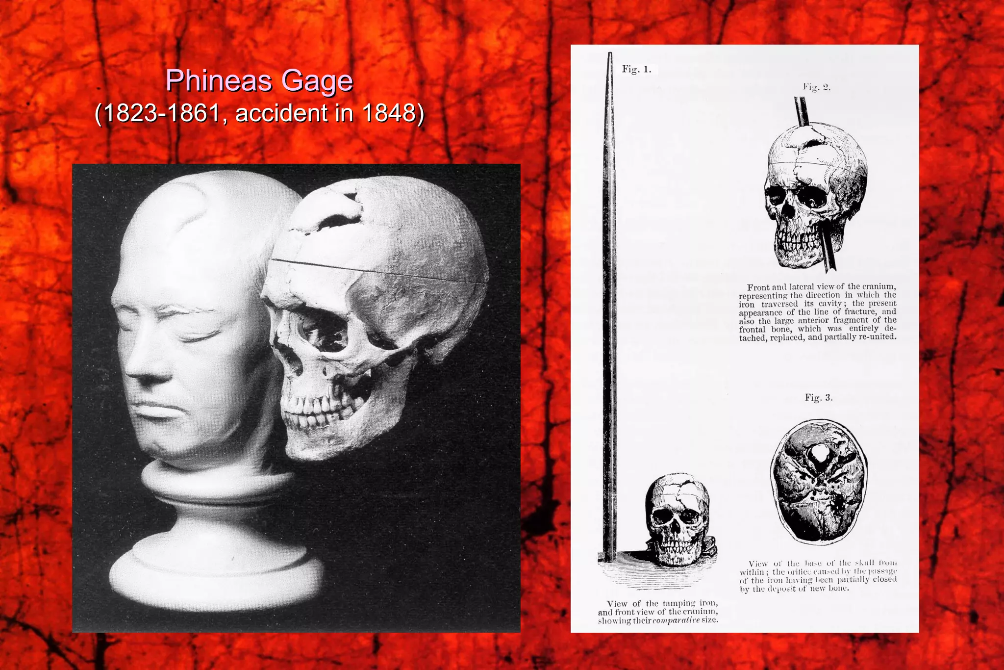 Phineas Gage (1823-1861, accident in 1848) 