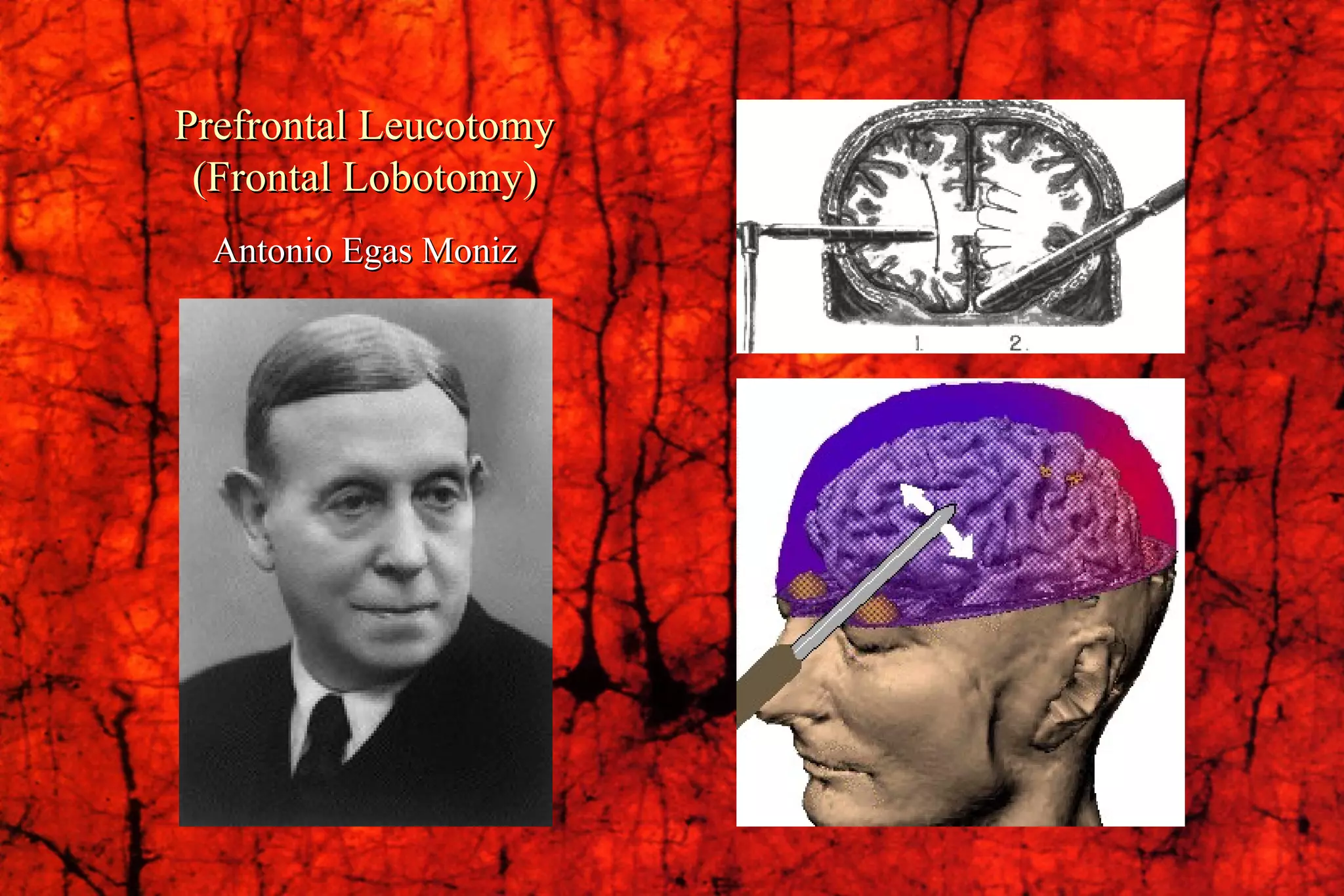 Prefrontal Leucotomy (Frontal Lobotomy) Antonio Egas Moniz 