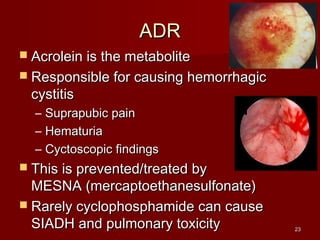 2233 
AADDRR 
 AAccrroolleeiinn iiss tthhee mmeettaabboolliittee 
 RReessppoonnssiibbllee ffoorr ccaauussiinngg hheemmoorrrrhhaaggiicc 
ccyyssttiittiiss 
– SSuupprraappuubbiicc ppaaiinn 
– HHeemmaattuurriiaa 
– CCyyccttoossccooppiicc ffiinnddiinnggss 
 TThhiiss iiss pprreevveenntteedd//ttrreeaatteedd bbyy 
MMEESSNNAA ((mmeerrccaappttooeetthhaanneessuullffoonnaattee)) 
 RRaarreellyy ccyycclloopphhoosspphhaammiiddee ccaann ccaauussee 
SSIIAADDHH aanndd ppuullmmoonnaarryy ttooxxiicciittyy 
 