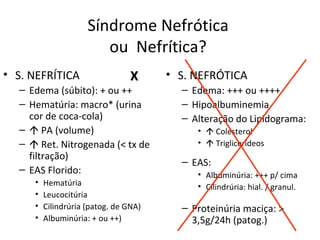 Síndrome Nefrótica  ou  Nefrítica?  S. NEFRÍTICA Edema (súbito): + ou ++ Hematúria: macro* (urina cor de coca-cola)    PA (volume)    Ret. Nitrogenada (< tx de filtração) EAS Florido: Hematúria Leucocitúria Cilindrúria (patog. de GNA) Albuminúria: + ou ++) S. NEFRÓTICA Edema: +++ ou ++++ Hipoalbuminemia Alteração do Lipidograma:    Colesterol    Triglicerídeos EAS: Albuminúria: +++ p/ cima Cilindrúria: hial. / granul. Proteinúria maciça: > 3,5g/24h (patog.) X 