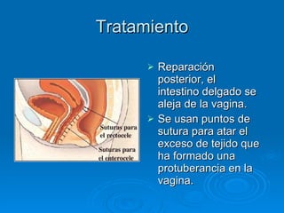 Tratamiento R eparación posterior ,  el intestino delgado se aleja de la vagina. Se usan puntos de sutura para atar el exceso de tejido que ha formado una protuberancia en la vagina. 