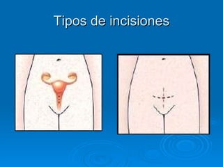 Tipos de incisiones                                              
